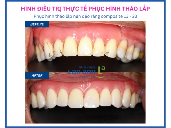 Phục hình tháo lắp