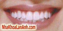 sau khi làm trắng răng Răng đã được tẩy trắng răng