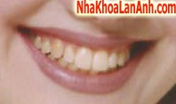 trước khi làm trắng răng truoc khi lam trang rang