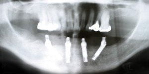 phim x.quang – panorama sau ca ghep 4 implant ham duoi.