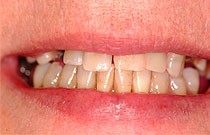 Porcelain_Bridge_Exton_dent_nha khoa