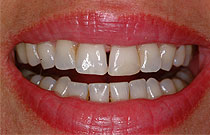 west_chester_teeth_bonding_nha khoa