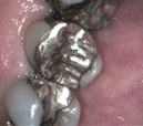 west_chester_teeth_whitenin_nha khoa