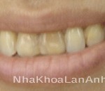 răng cửa bị tetracyline rang cua bi tetracyline