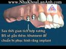 implant nha khoa cấy trụ implant nha khoa cay tru