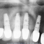 implant rang toan ham