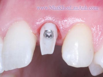 Gan Abutment tren 