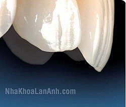 veneer răng sứ nhiều chủng loại veneer rang su nhieu chung loai trong truong hop mat rang