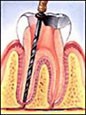 lấy tủy răng – răng sẽ không còn sự sống khi lấy tủy lấy tủy răng đề phòng sâu răng. tag: giá răng sứ