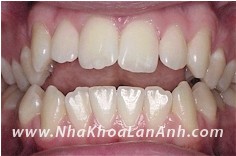 Cac rang khong cham nhau