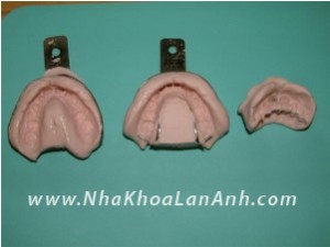 Dau Alginate sau khi lay mau