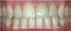 Gan rang tren Implant