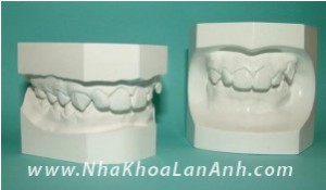 Ham rang bang Alginate