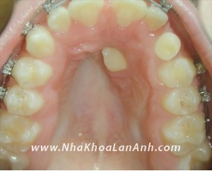 Rang nanh moc ngam