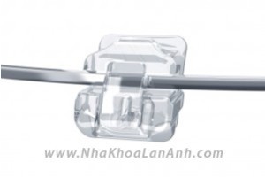 Chỉnh nha Mac cai tu buoc Damon Clear _ nieng rang co dau khong