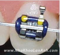 Mo hinh phong to mac cai