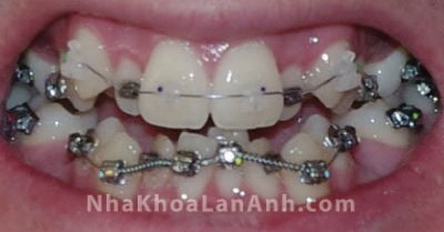 Hình: một ca điều trị chỉnh nha thực tế ngay sau khi gắn mắc cài, nieng rang co dau khong