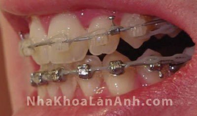 Hình: ca điều trị chỉnh nha sau 8 tháng. Hình do bệnh nhân tự chụp.