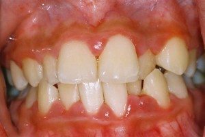 nướu bị viêm - nha khoa nuou bi viem - nha khoa