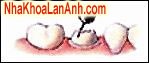 Cạo ra phần bị sâu-răng giả Cao ra phan bi sau-rang gia