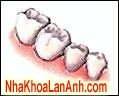 nha sĩ sẽ lấy mão tạm thờ-răng giả nha si se lay mao tam tho-rang gia