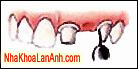 chụp răng-răng giả chup rang-rang gia