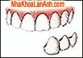 đặt một cầu răng-răng giả dat mot cau rang-rang gia