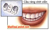 cầu răng cố định-răng giả cau rang co dinh-rang gia