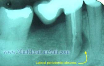 phim implant toan ham