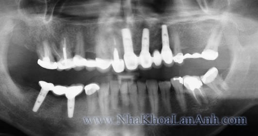 Phuc hinh cau rang tren Implant