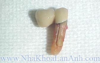Chan rang implant