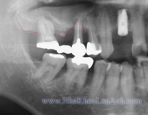 implant_phim xq