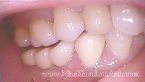 Cau rang tren Implant