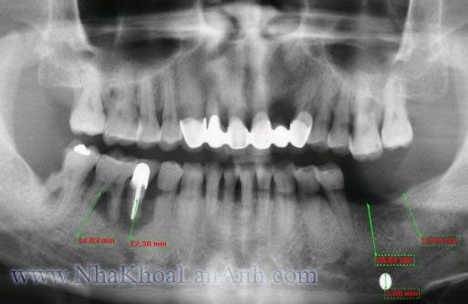 implant_xq nguyen ham