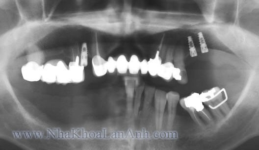 xquang rang toan ham_implant