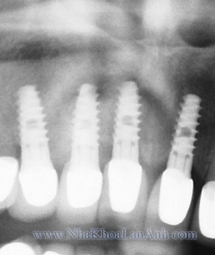 film implant ham tren