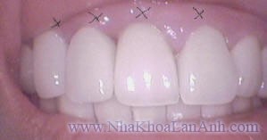 hinh sau khi implant toan ham