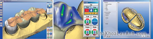 quy trình răng sứ_cerec_inlab quy trinh rang su_cerec_inlab