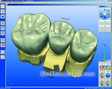 răng sứ_cerec_inlab_nha khoa rang-su-cerec-inlab-nha-khoa-Răng thẩm mỹ