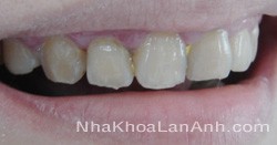 Răng bị nhiễm ngả màu xám sậm - răng Rang bi nhiem nga mau xam sam - rang