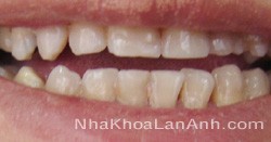 răng thiểu sản men - răng rang thieu san men - rang