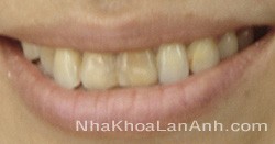Răng bị nhiễm có màu vàng sậm - răng Rang bi nhiem co mau vang sam - rang