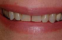 Downingtown_Dental_Inceram_nha khoa