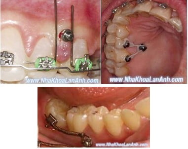 implant chinh nha