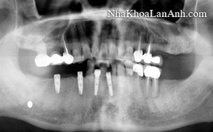 xquang toan canh rang gia - răng giả xquang toan canh rang gia - rang gia