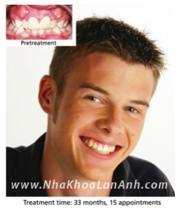 Benh nhan co 3 rang ngam