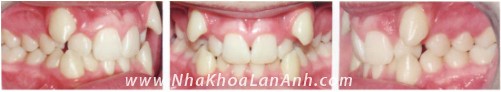 Benh nhan co 2 rang khenh