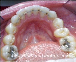 Day duy tri duoc gan co dinh: tag: nha khoa tốt ở tphcm