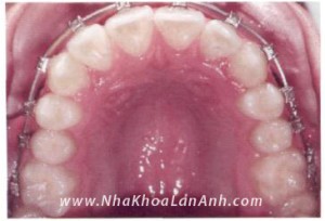 Rang nanh vao trong cung ham