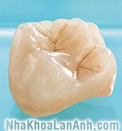 Răng sứ màu sắc đẹp, tự nhiên Rang thẩm mỹ mau sac dep, tu nhien